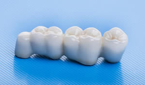 3-corona-ceramica-1-300x177