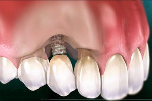 Perlimplantitis Perlimplantitis