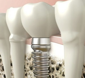 Endodoncia e Incrustación